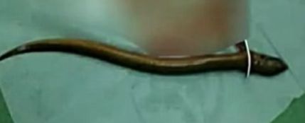 Extirpan una anguila del intestino de un hombre Extirpan una anguila del intestino de un hombre